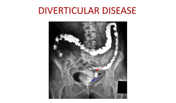 diverticular-disease-explained_featured