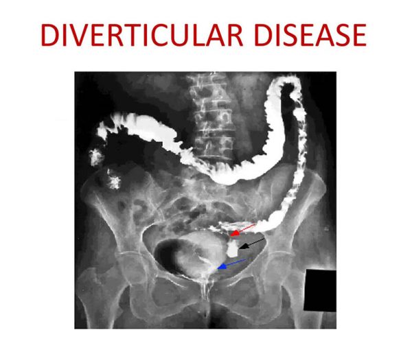 diverticular-disease-explained_featured
