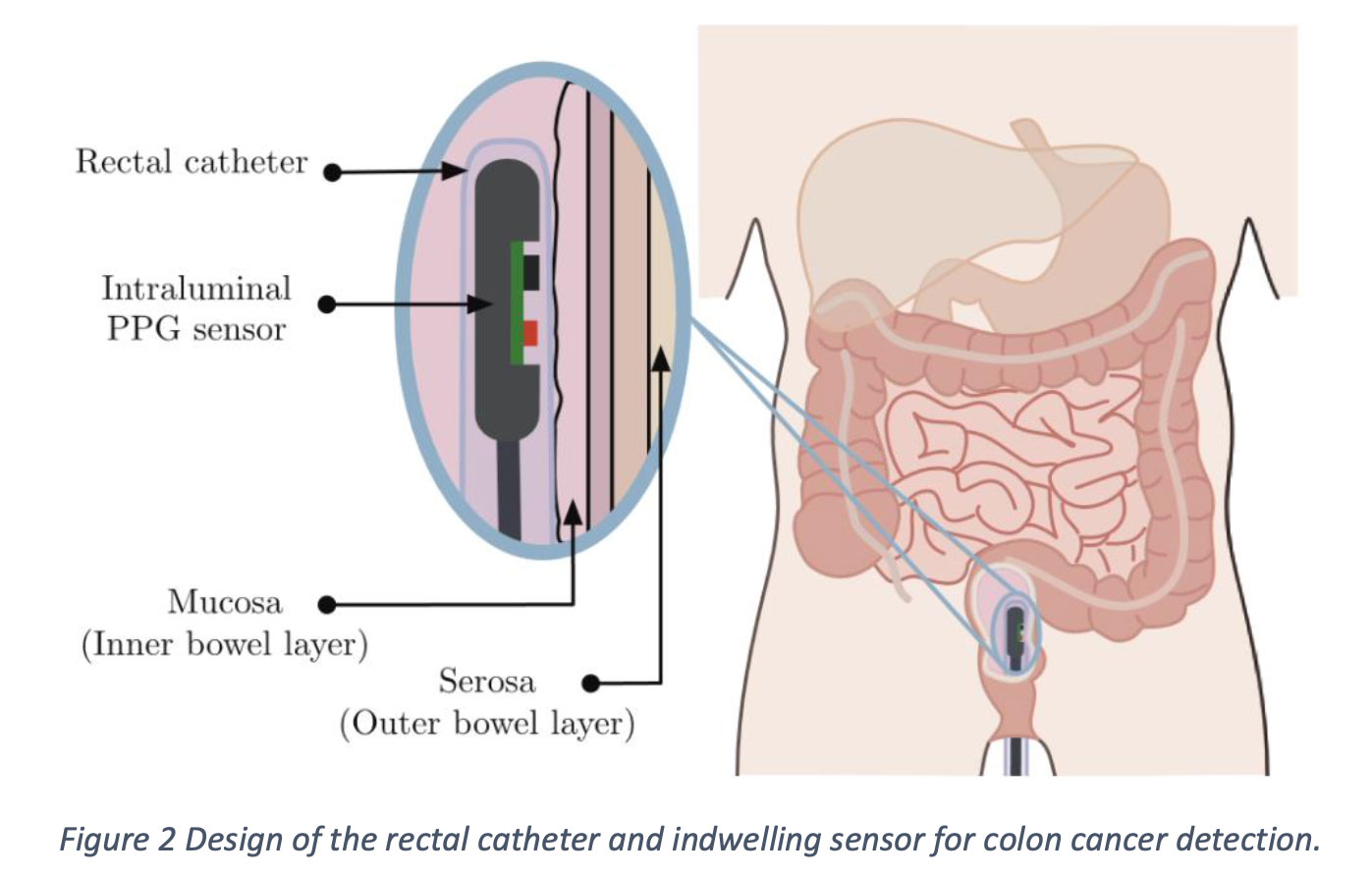 Design of the rectal catheter and indwelling sensor for colon cancer detection